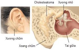 Gia truyền nhiều đời Viêm tai xương chũm