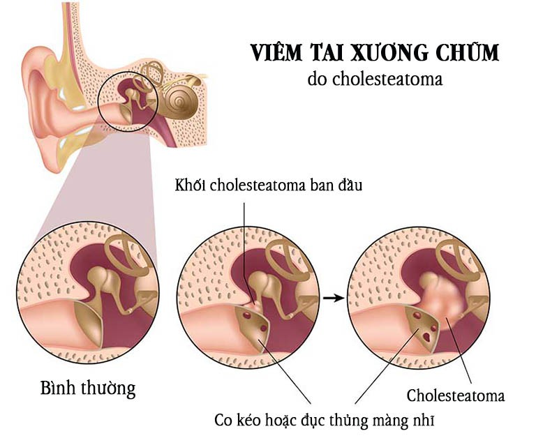 Chuyên chữa Viêm tai Xương chũm
