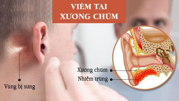 Triệu chứng viêm tai xương chũm