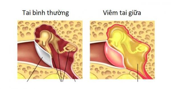 Đông y Viêm tai xương chũm