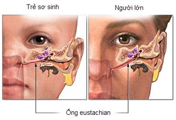 Nam dược Viêm tai giữa