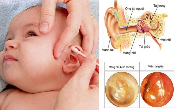 Nam y Viêm tai giữa