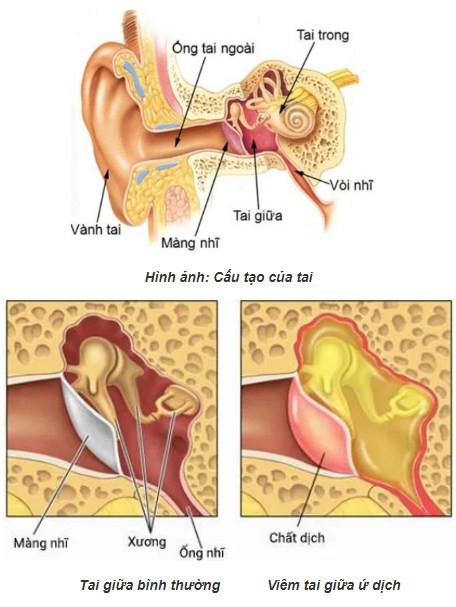 Mổ viêm tai giữa