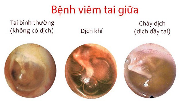 Nguyên nhân viêm tai giữa