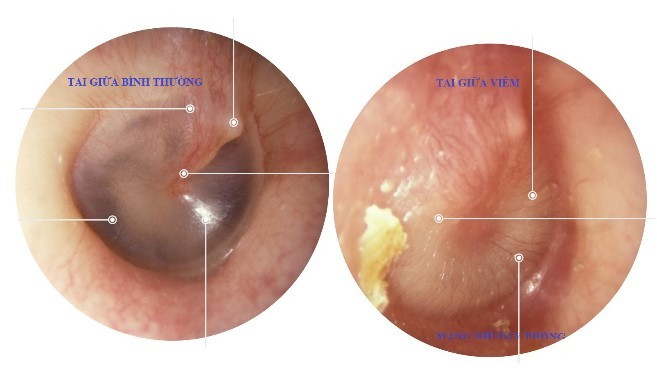 Chữa bệnh viêm tai giữa