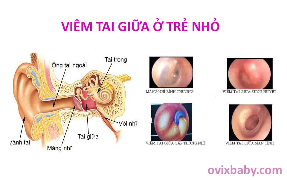 Viêm tai giữa