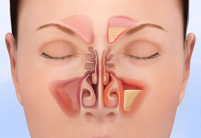 Bị viêm xoang mũi kinh niên vì những lý do không ngờ